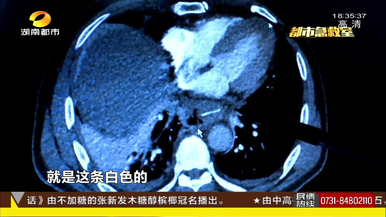 男子醉酒误吞3公分鱼刺