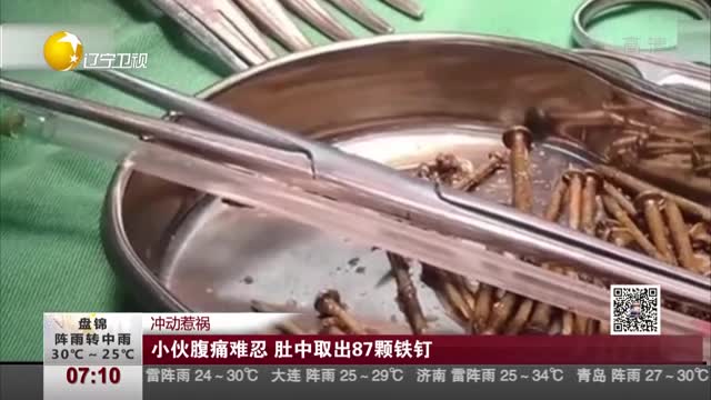 [视频]冲动惹祸：小伙腹痛难忍 肚中取出87颗铁钉