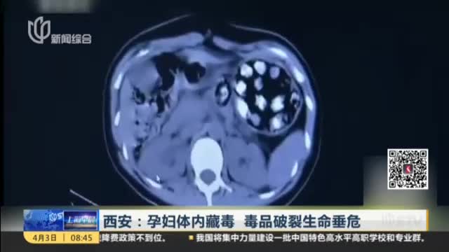 [视频]西安：孕妇体内藏毒 毒品破裂生命垂危 