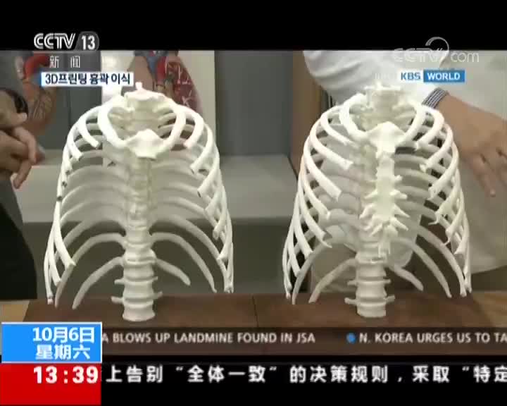 [视频]韩国首例3D打印胸廓移植成功