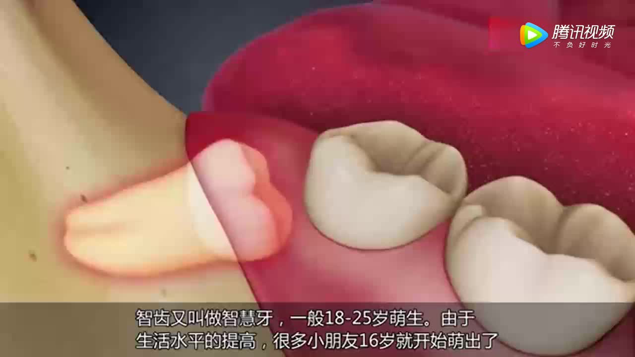 [视频]智慧牙到底该不该拔 原来都做错了！