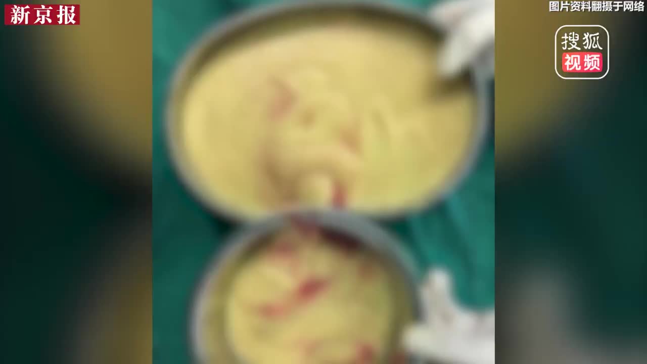 [视频]女子注射隆胸 16年后取出500毫升“玉米糊”