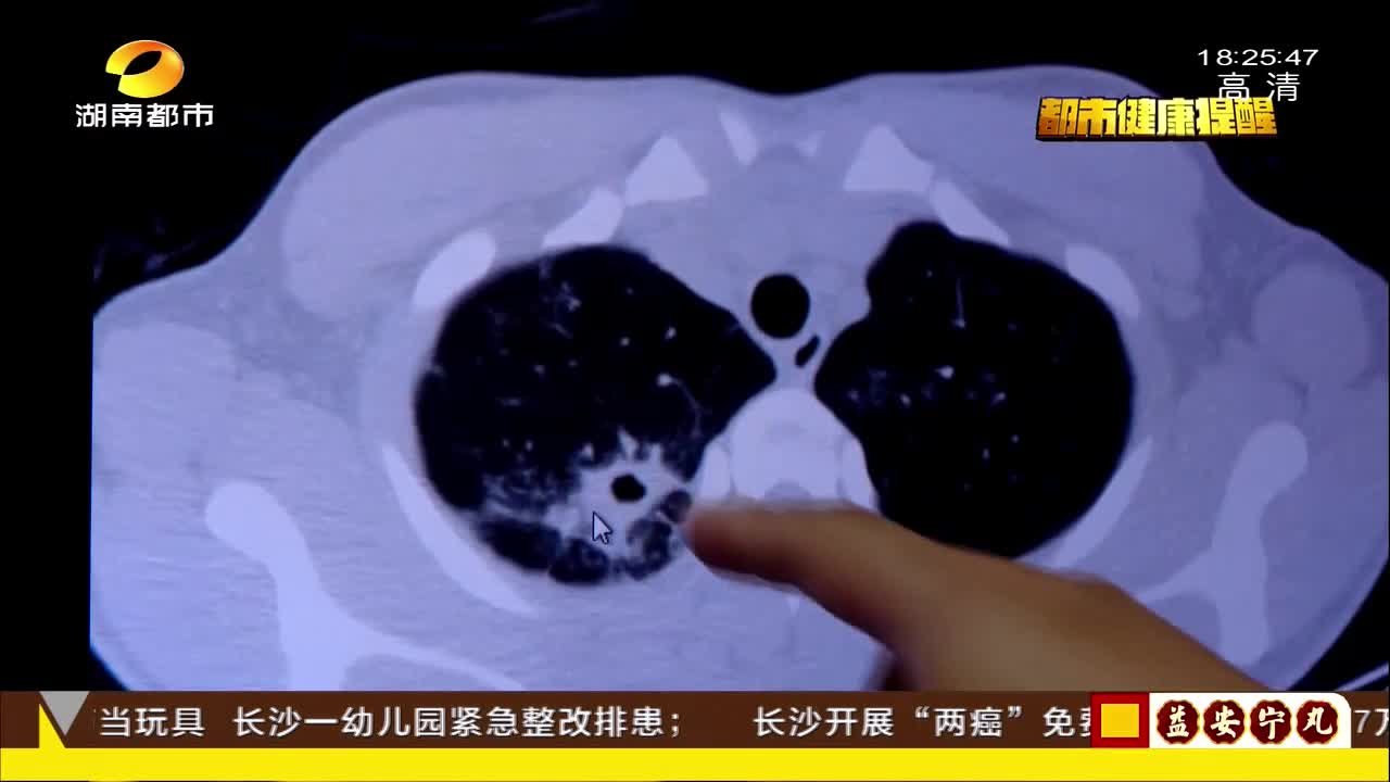 26岁女子“吃着火锅”突咳血 竟是患上空洞型肺结核